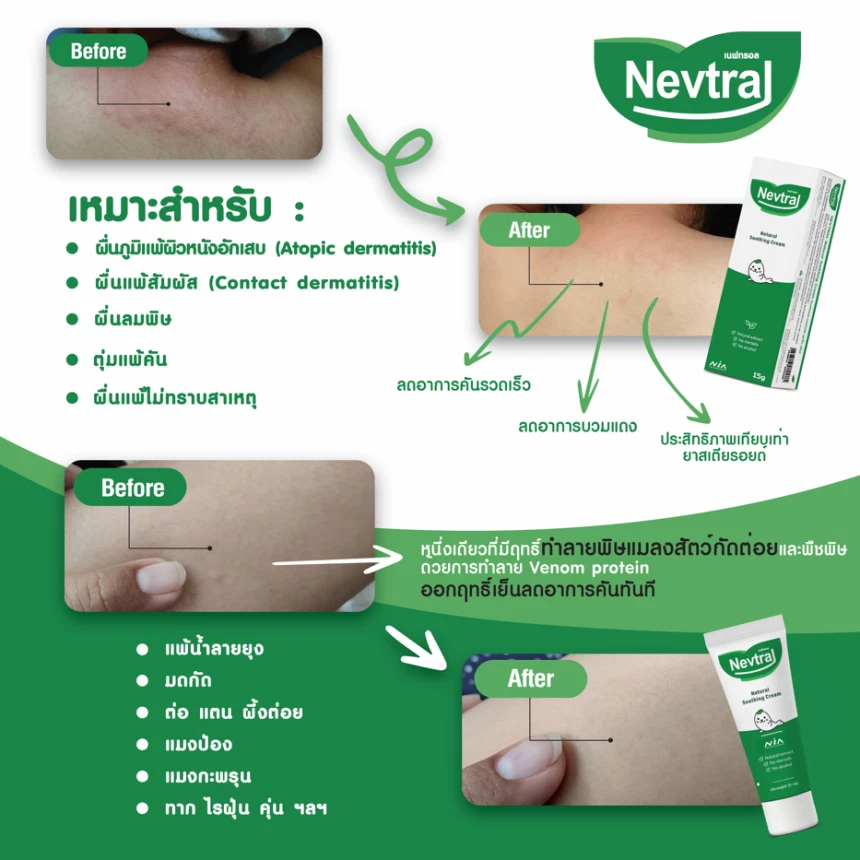 เนฟทรอล ครีม จากสารสกัดธรรมชาติ สำหรับแก้แพ้ ผดผื่นคัน แมลงสัตว์กัดต่อย สูตรอ่อนโยน 15g.